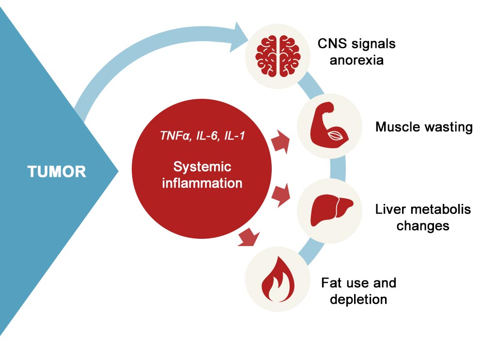 fisiopatologia-malnutrizione-neoplasia