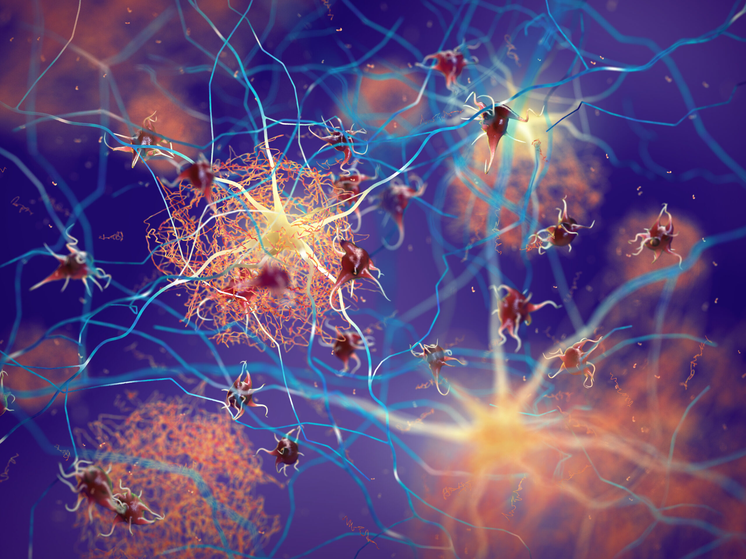 Amyloid,Plaques,Forming,Between,Neurons,3d,Ilustration.,Beta-amyloid,Protein,Disrupting
