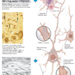 Microscopic Pathology In Alzheimer's Disease