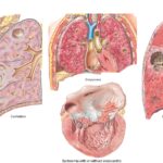 Complications of Hospital-Acquired Pneumonia