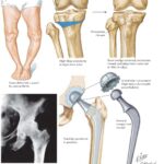 Surgical Alternatives for Osteoarthritis