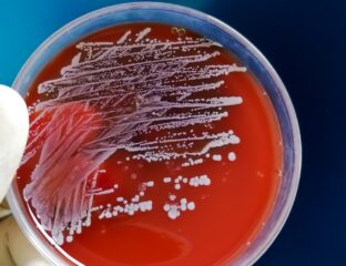 Microbiologia Fibrosi Cistica: Approcci e Campionamento