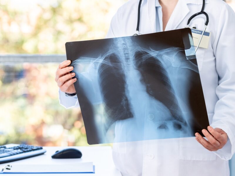 le infezioni polmonari associate alla Fibrosi Cistica