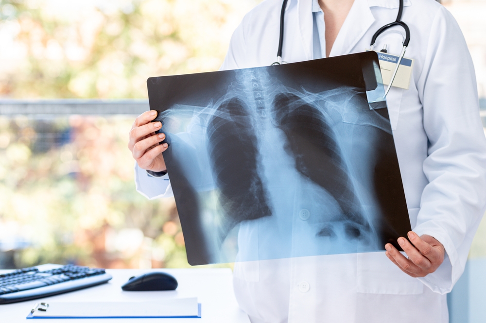 le infezioni polmonari associate alla Fibrosi Cistica
