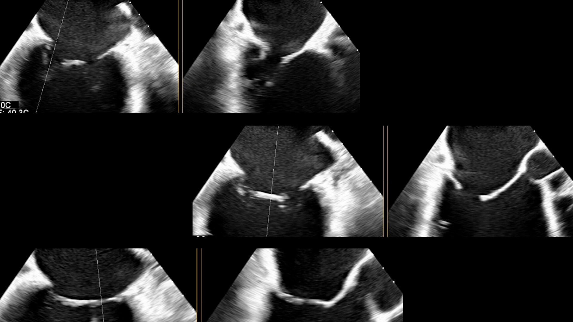 L’ecografia 3D per lo studio delle valvole cardiache