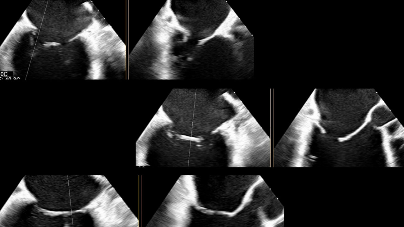 L’ecografia 3D per lo studio delle valvole cardiache