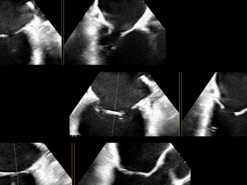 L’ecografia 3D per lo studio delle valvole cardiache
