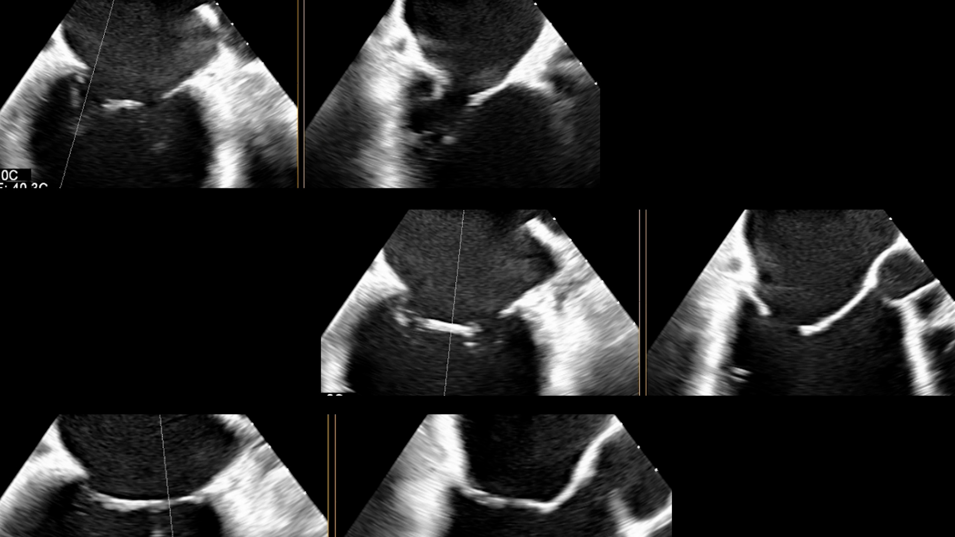 L’ecografia 3D per lo studio delle valvole cardiache
